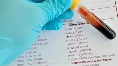 tumor-marker-blood-test-panel Gloved hand holding a blood sample next to a tumor marker lab requisition form